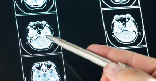 Brain Tumour Surgery