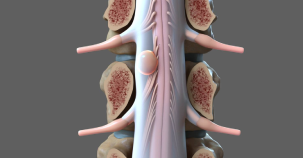 Spinal Cord Tumour Surgery