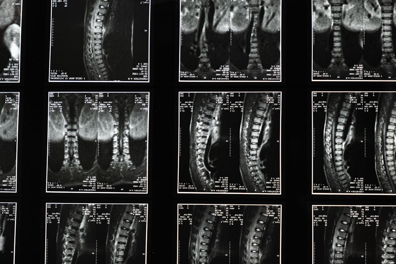 Disc Replacement Surgery